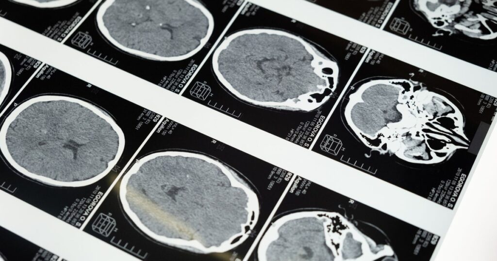 Brain Scans Reveal a Hidden Alzheimer’s Window - Featured image