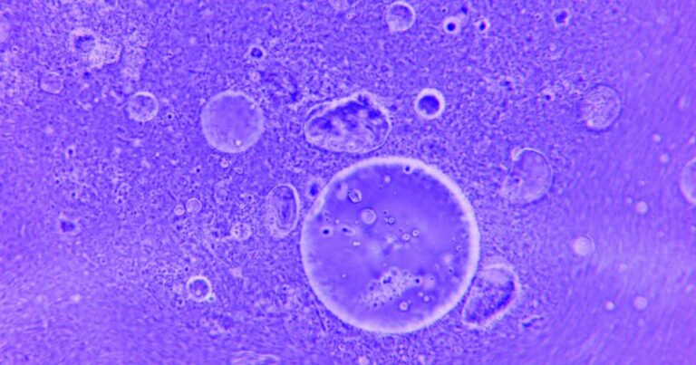 How Glioma Brain Cancer Hijacks Your Own Neurons to Grow - Featured image