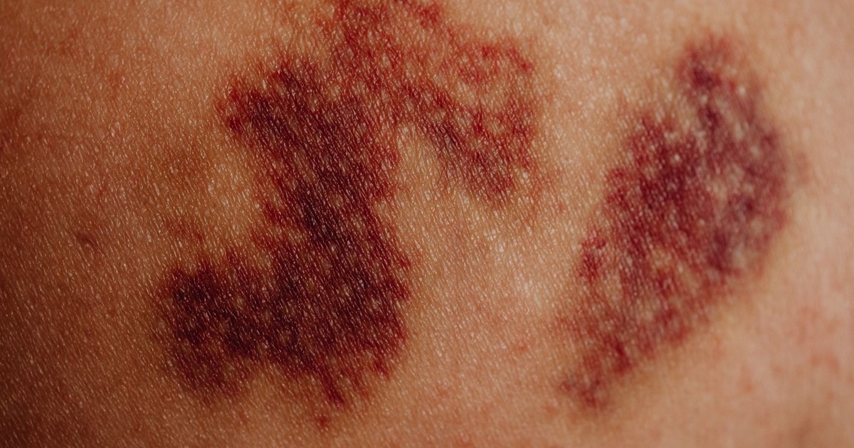 Detailed close-up of a bruise on skin showing purplish discoloration and texture.