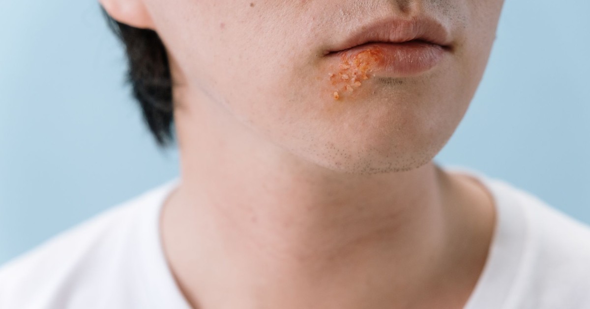 The Chickenpox Virus Never Really Left — and It Can Cause Serious Hidden Illness