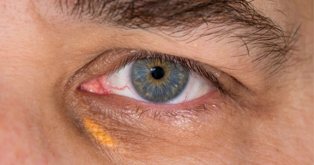 Those Little Yellow Eye Patches May Be a Warning Sign of Heart Attack or Stroke - Featured image