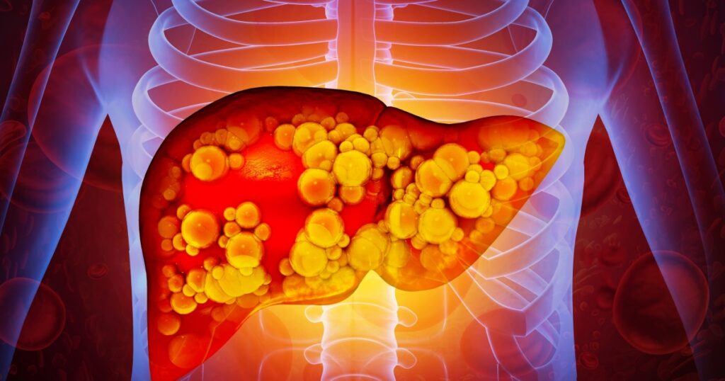 Your Fatty Liver Could Be Hurting Your Heart and Kidneys Too - Featured image