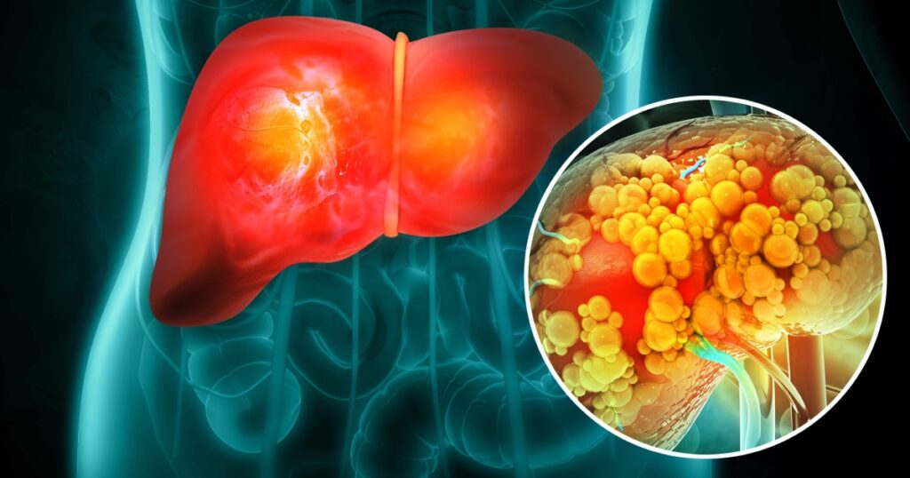 Could Keto Be Better for Your Liver? New Study Reveals a Potential Benefit - Featured image