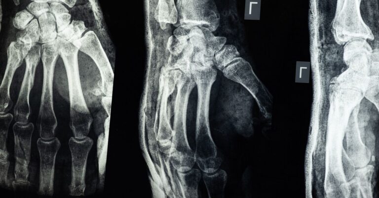 Osteoporosis Patients Had 94% Fewer Fractures After a Single Stem Cell Infusion in Early Trial - Featured image