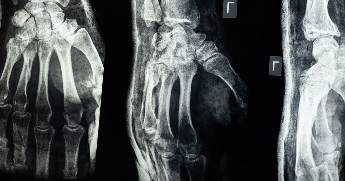 Osteoporosis Patients Had 94% Fewer Fractures After a Single Stem Cell Infusion in Early Trial